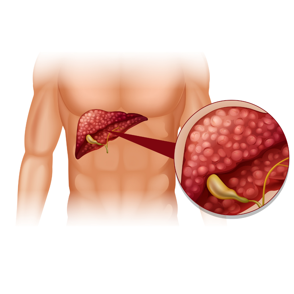 Pancreatic Cancer