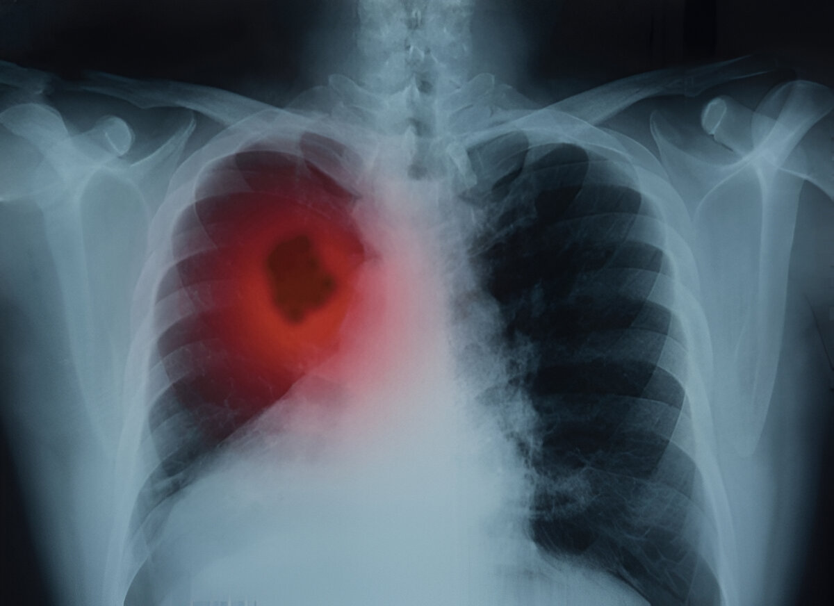 Lung Cancer