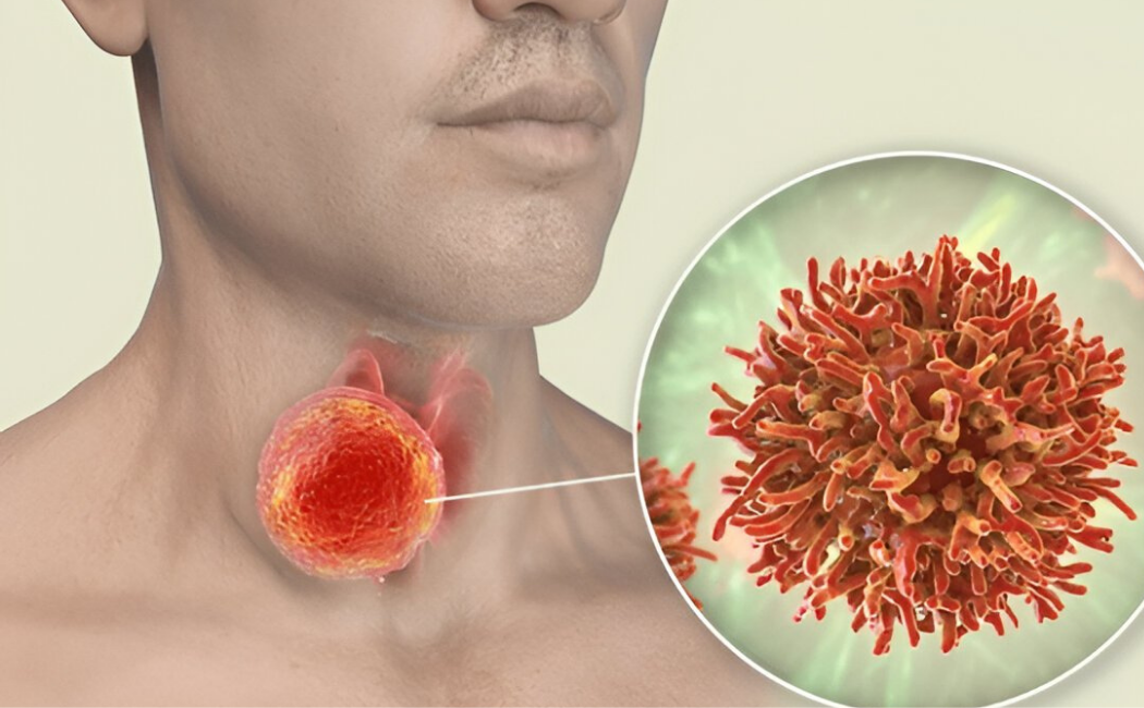 Thyroid cancer