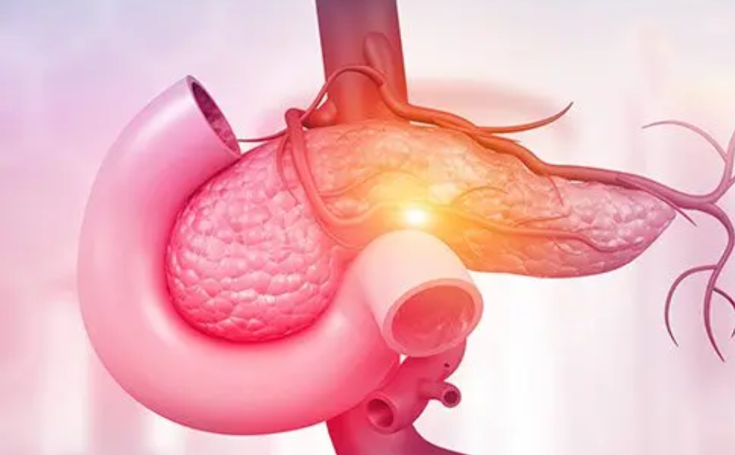 Pancreatic Cancer
